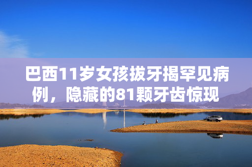 巴西11岁女孩拔牙揭罕见病例，隐藏的81颗牙齿惊现